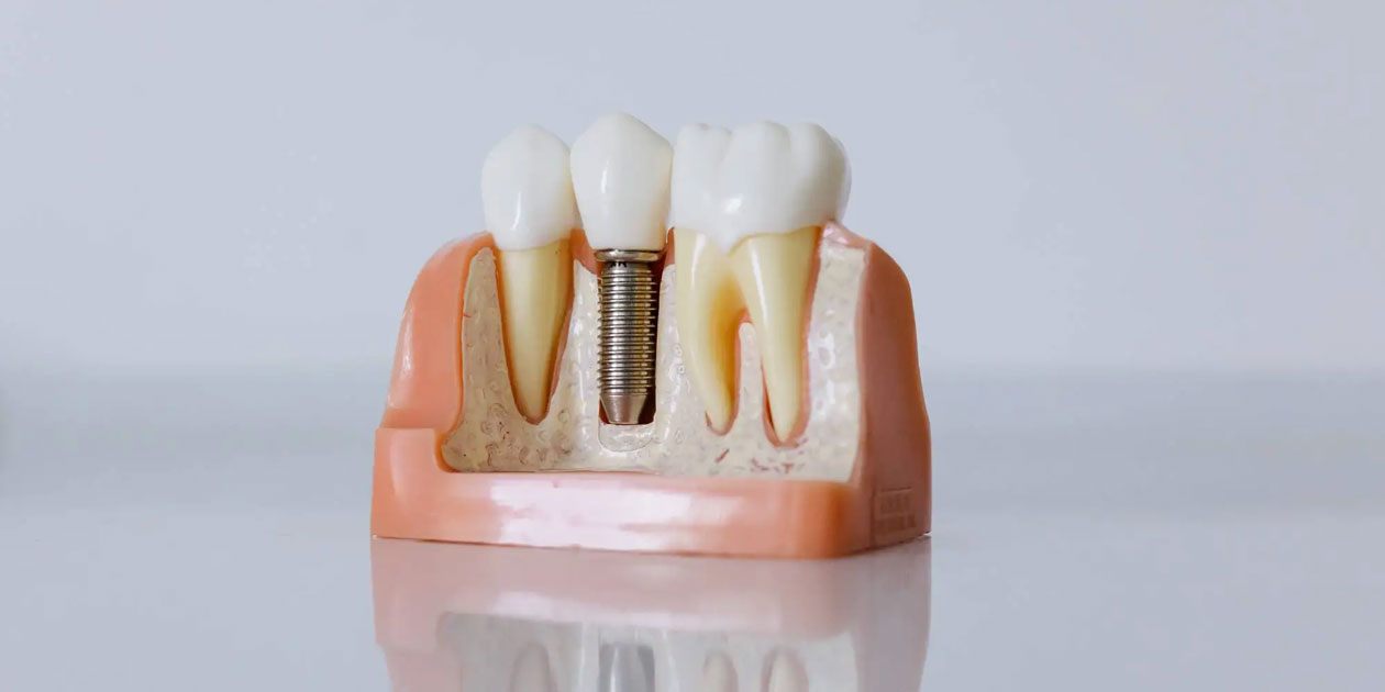 Dental Implants in Foothill Ranch